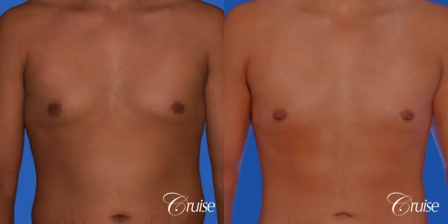 26yr old with mild gynecomastia - Before and After 1