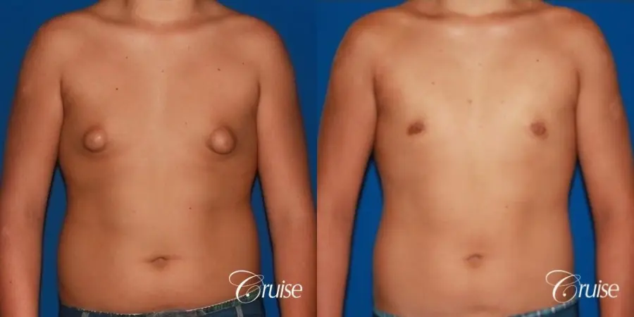 severe puffy nipple on teenager - Before and After 1