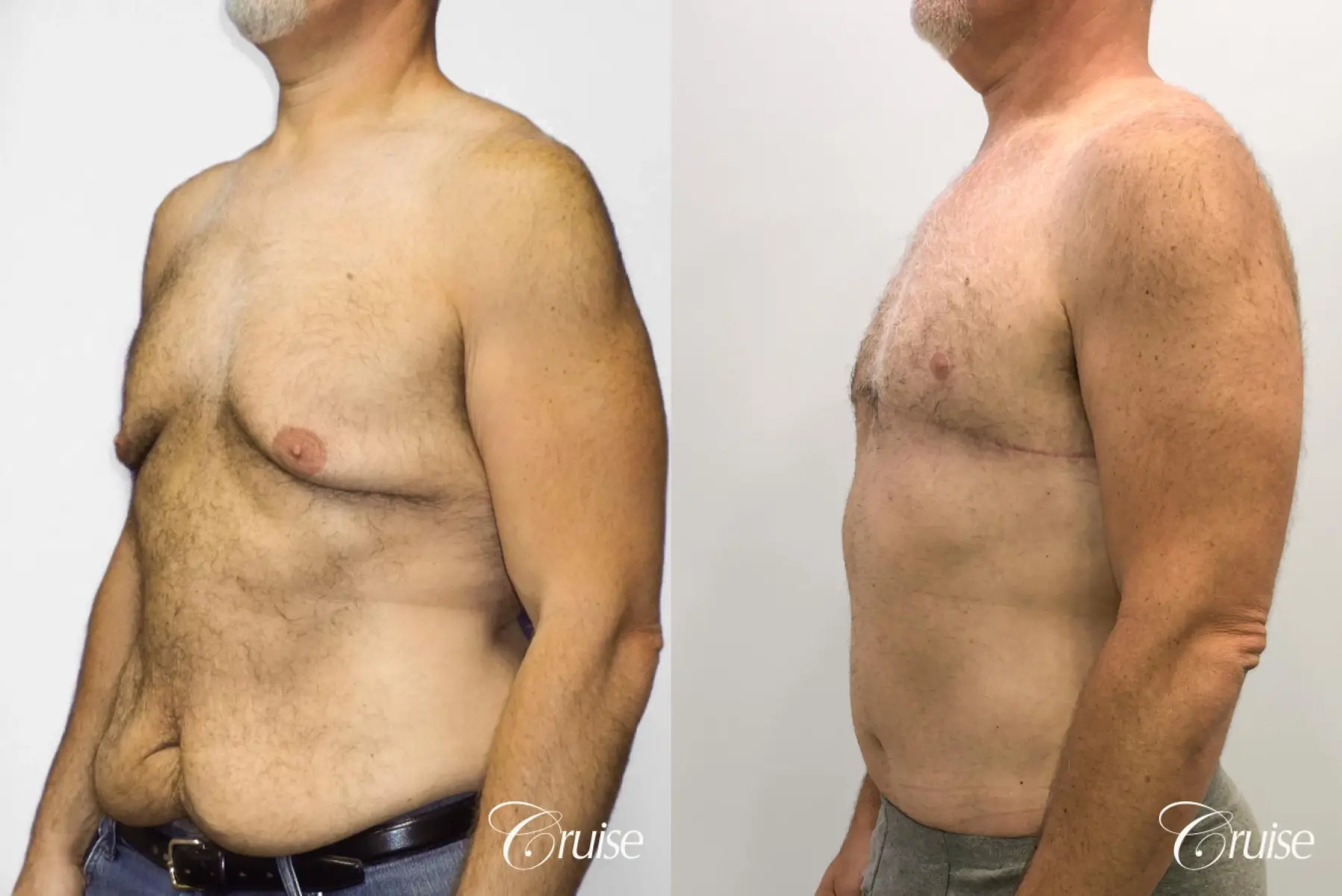 Gynecomastia: Patient 144 - Before and After 2