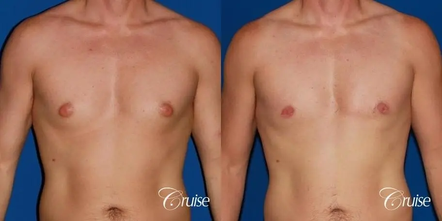 puffy nipple on low body fat - Before and After 1