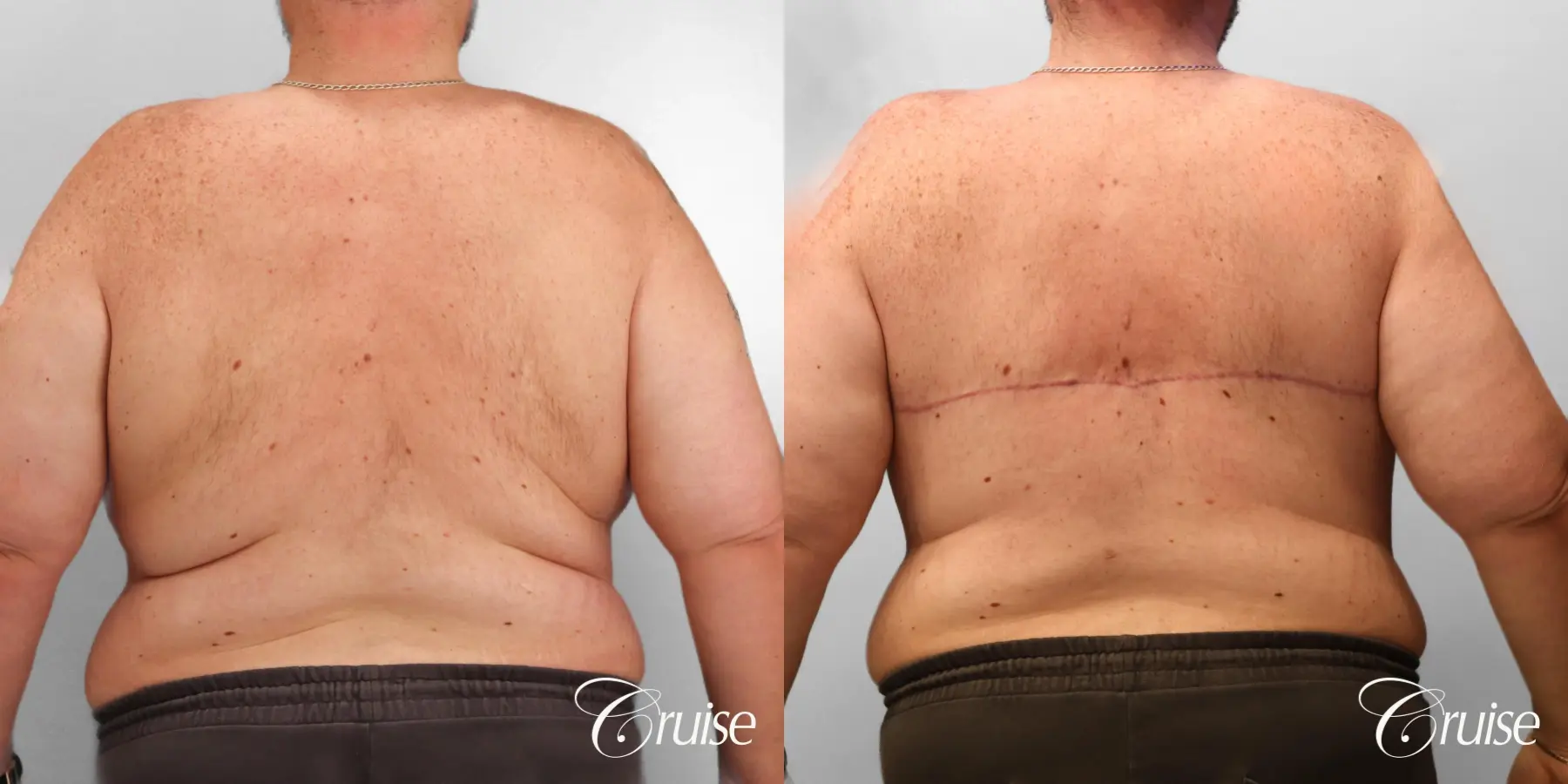 Gynecomastia: Patient 145 - Before and After 4
