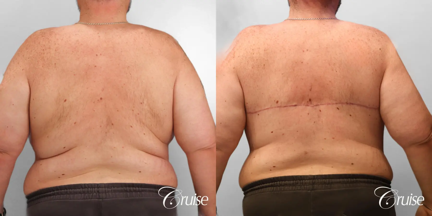 Gynecomastia: Patient 149 - Before and After 4