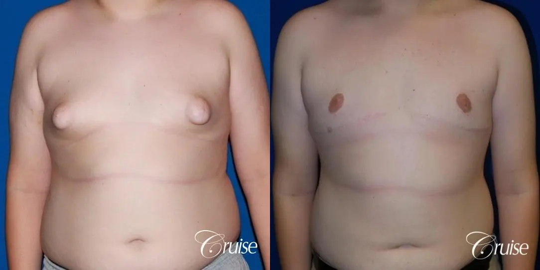 young boy with gynecomastia during puberty gets surgery - Before and After 1