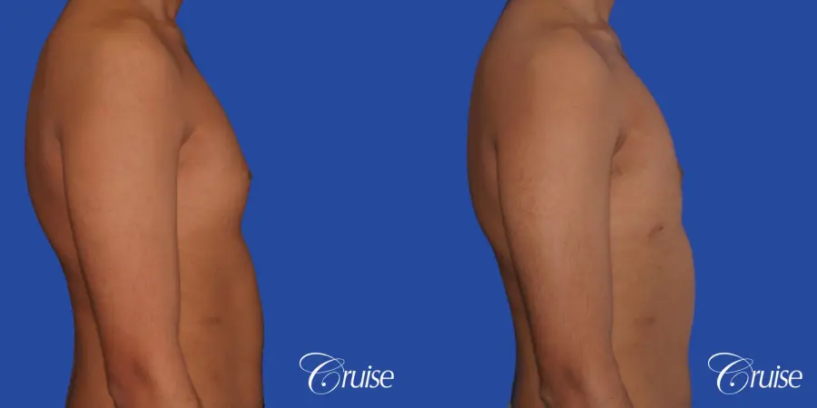 best before and after results for gynecomastia surgery - Before and After 3