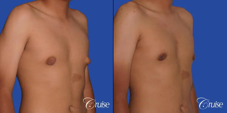 gynecomastia patient gets nipple reduction for best results - Before and After 5