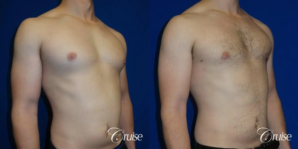 Adult gynecomastia before and after photos - Before and After 2