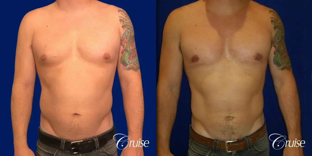 gynecomastia with skin laxity - Before and After 1