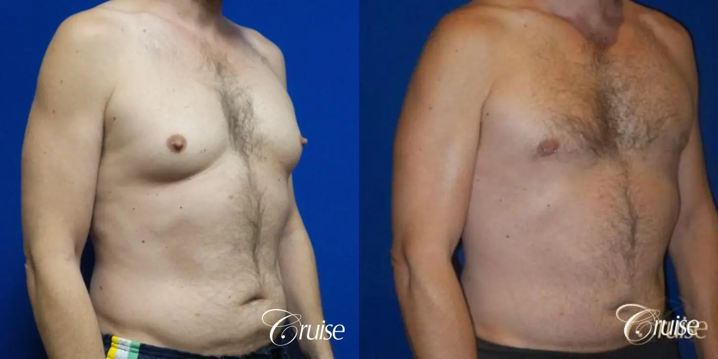 Best Gynecomastia surgeons Los Angeles - Before and After 2