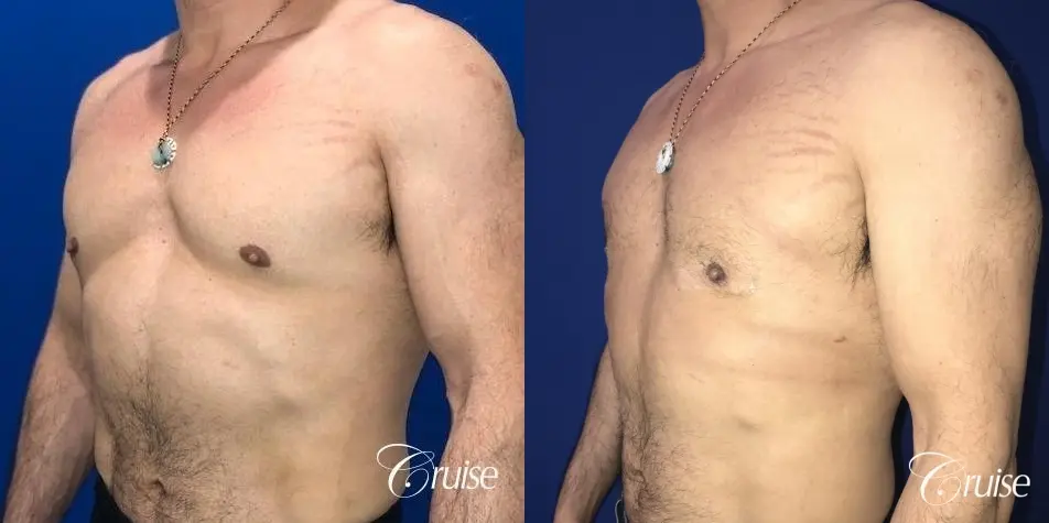 Gynecomastia: Patient 142 - Before and After 2