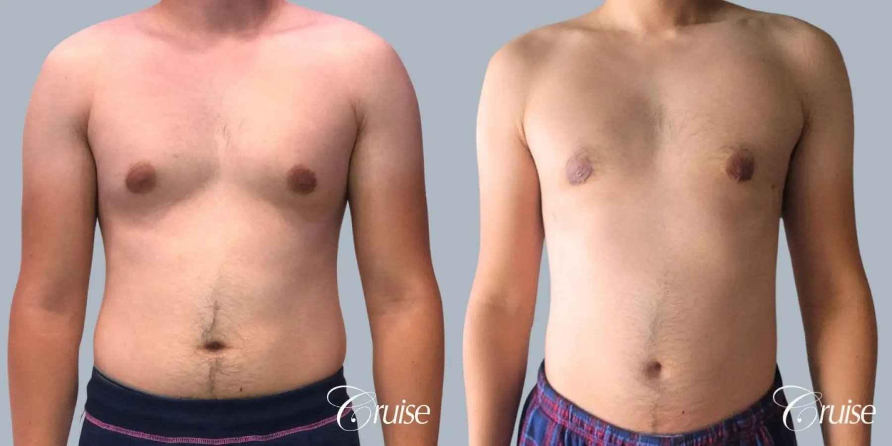 Gynecomastia: Patient 151 - Before and After 1