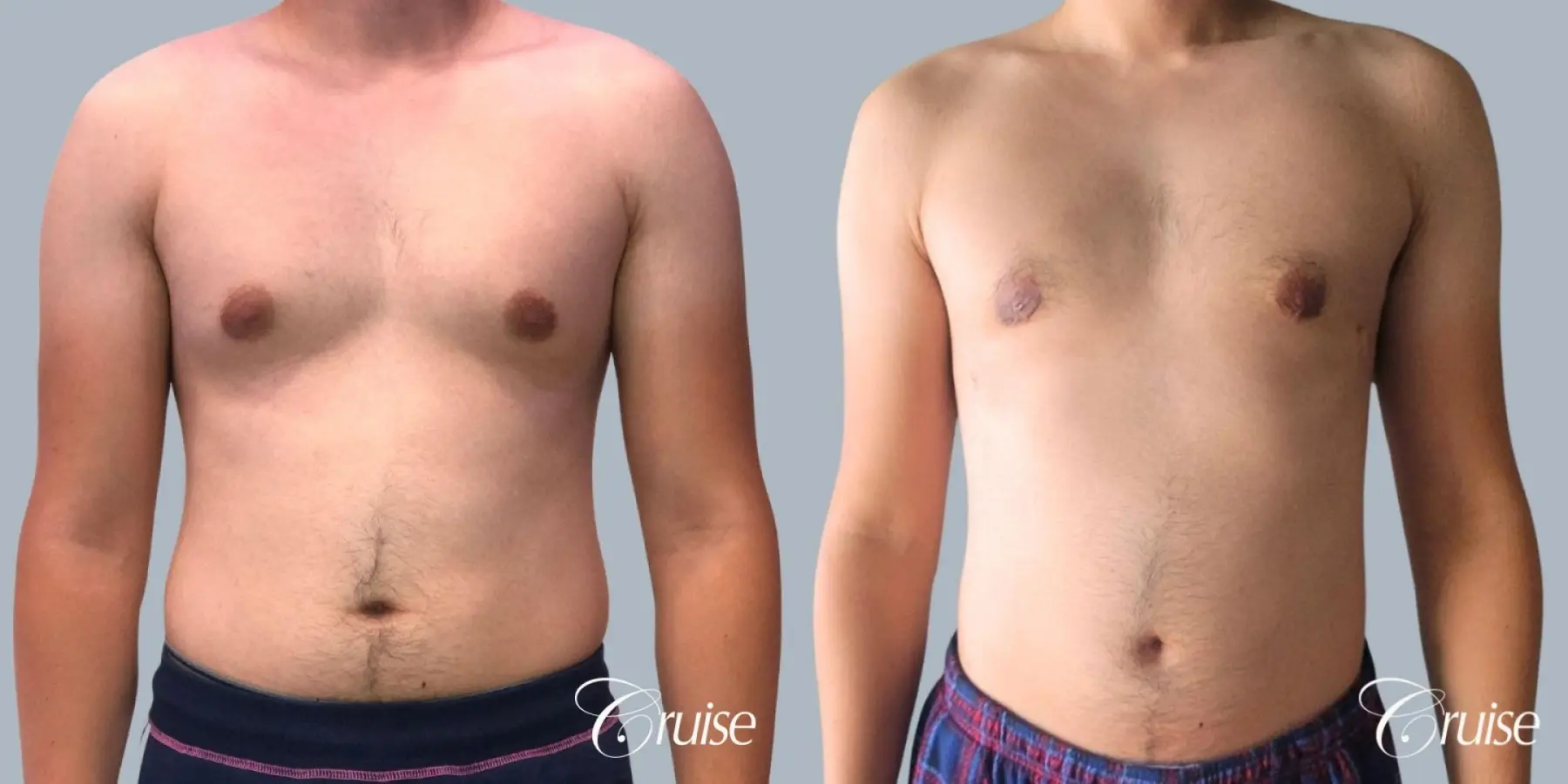 Gynecomastia: Patient 155 - Before and After 1