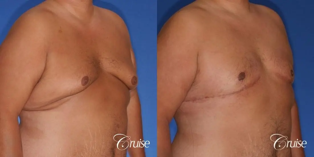 free nipple graft gynecomastia results - Before and After 2