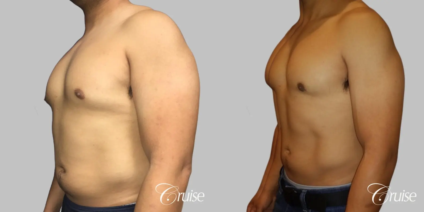 Type 2 Gynecomastia with Areola Incision - Before and After 2