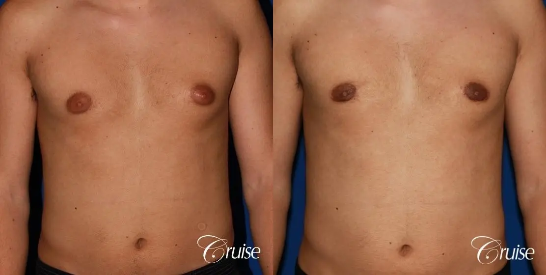 mild gynecomastia before and after with puffy nipple - Before and After 1