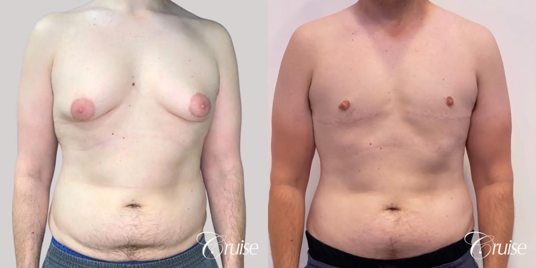 Gynecomastia: Patient 149 - Before and After 1