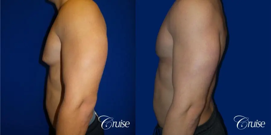 Best before and after gynecomastia pictures - Before and After 3