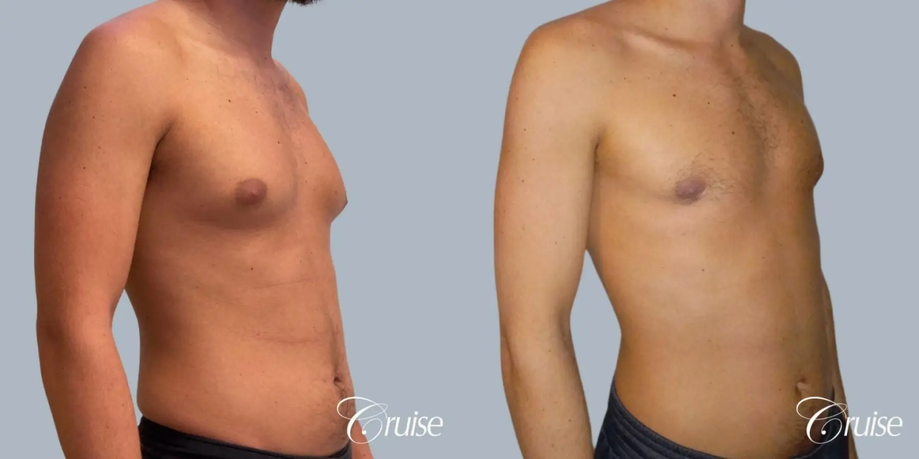 Gynecomastia: Patient 154 - Before and After 2