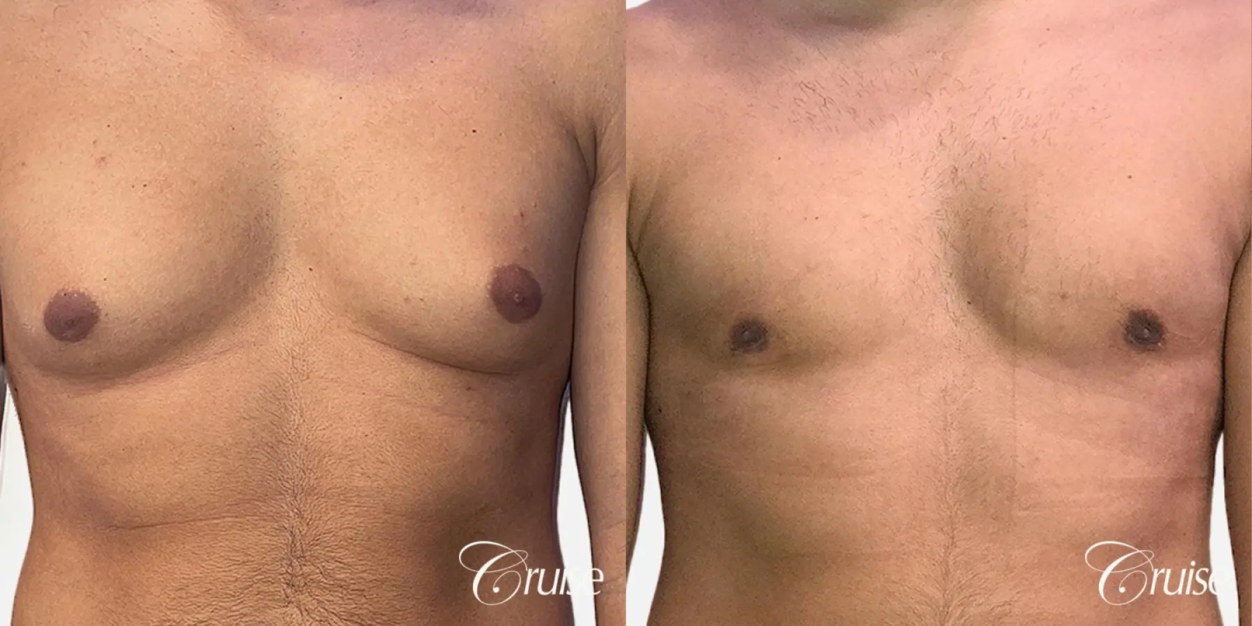 Type 2 Latino Gynecomastia Removal - Before and After 1
