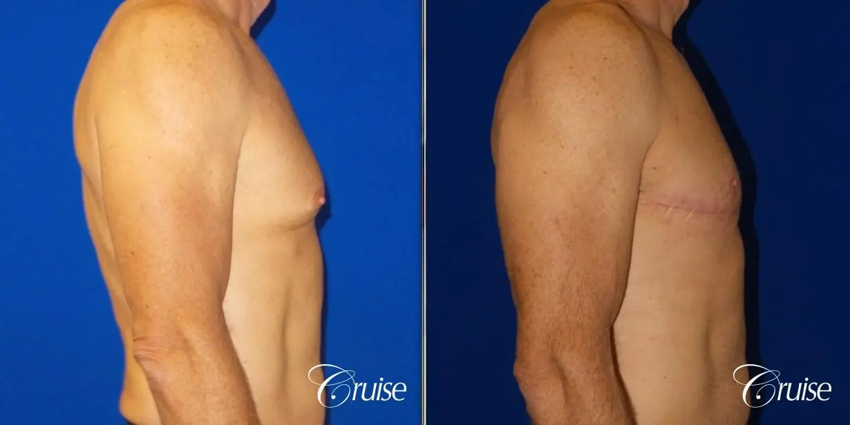 Top Gynecomastia surgeon Newport Beach - Before and After 4