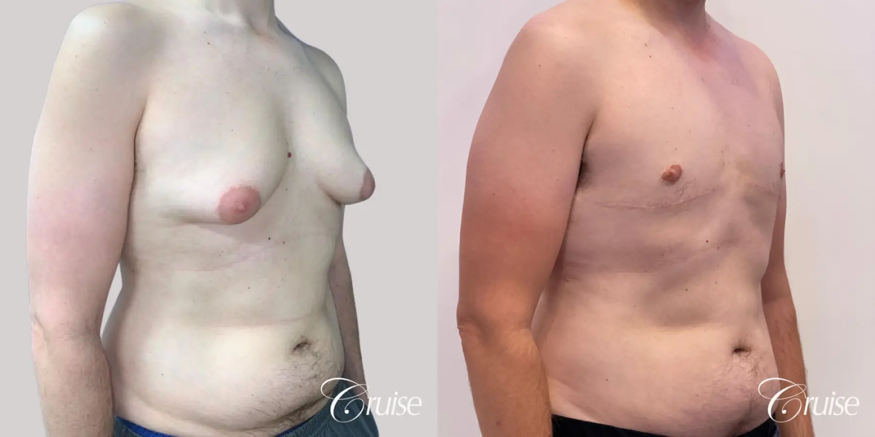 Gynecomastia: Patient 149 - Before and After 2