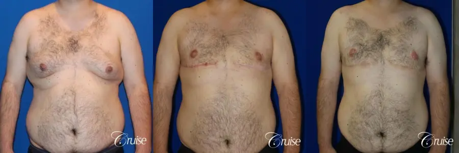 gynecomastia with free nipple graft - Before and After 1