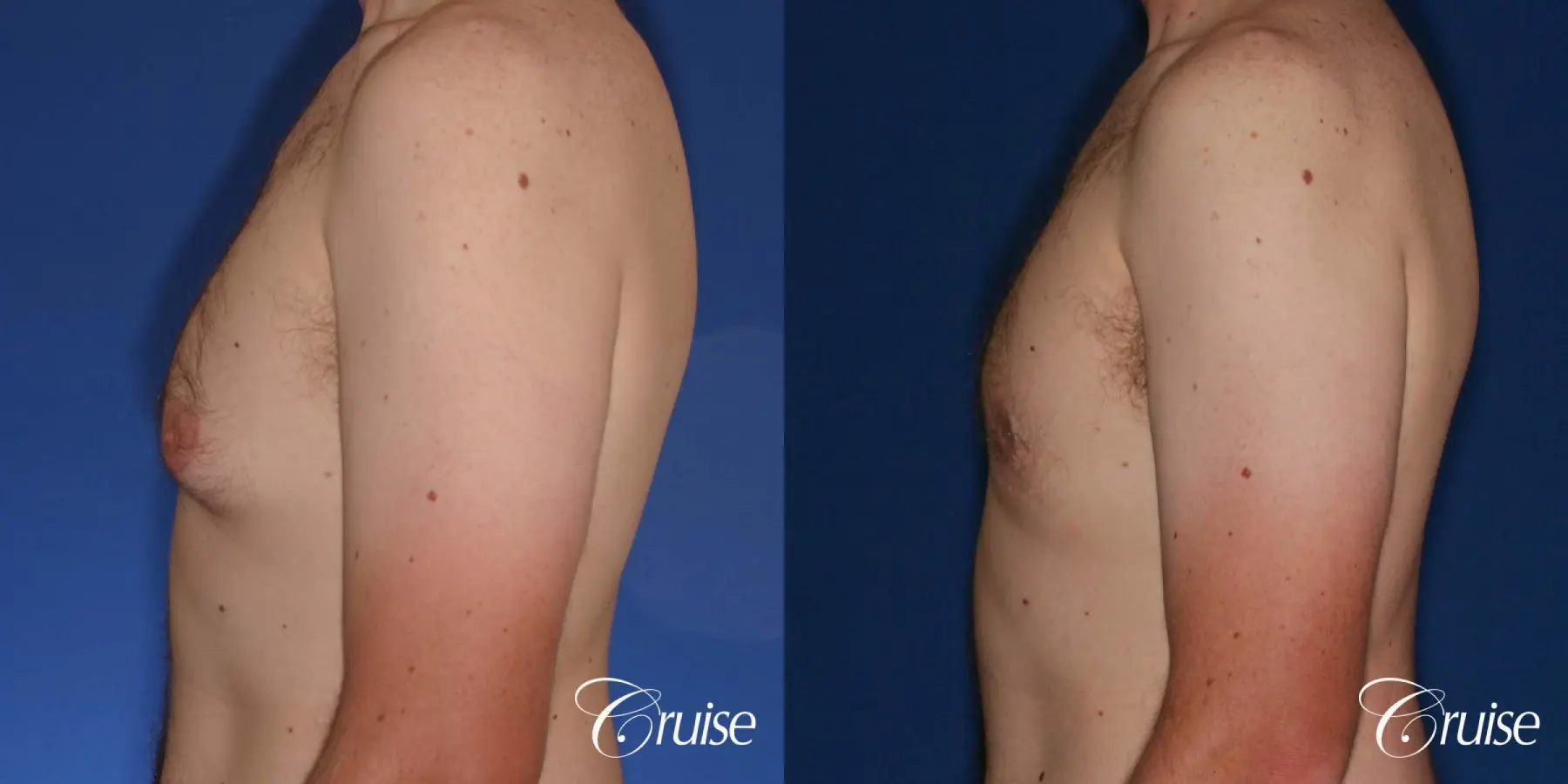 gynecomastia with skin laxity - Before and After 2