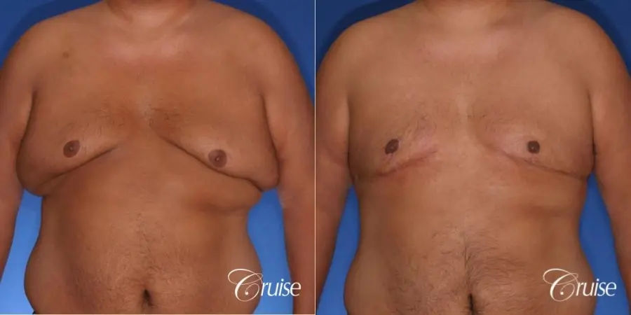 free nipple graft gynecomastia results - Before and After 1