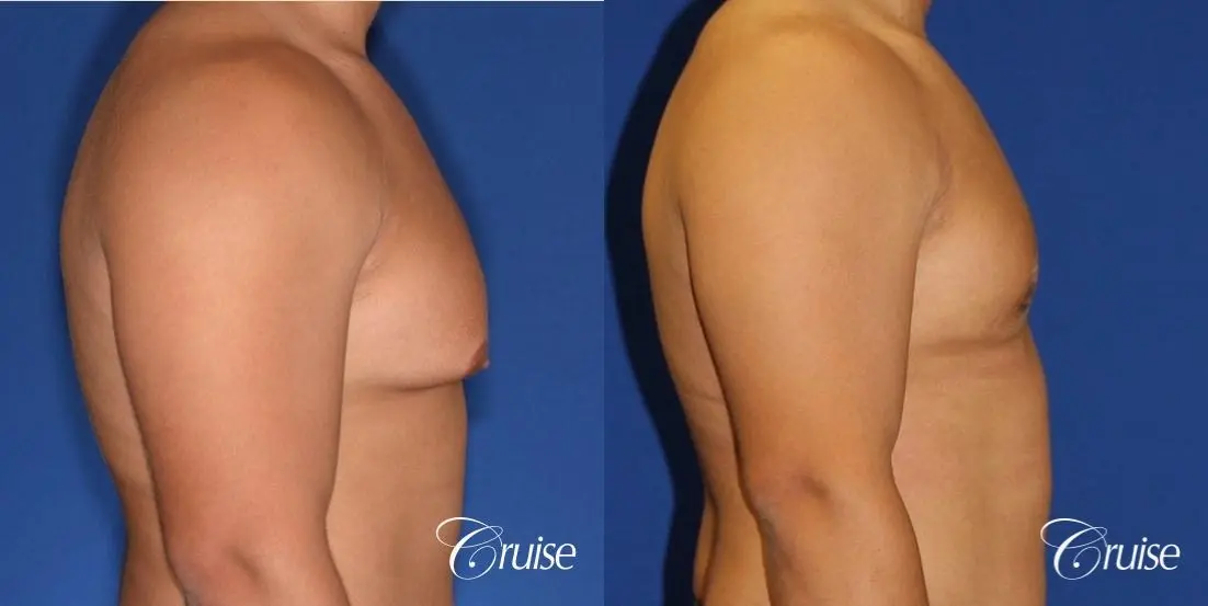 donut lift gynecomastia moderate adult - Before and After 3