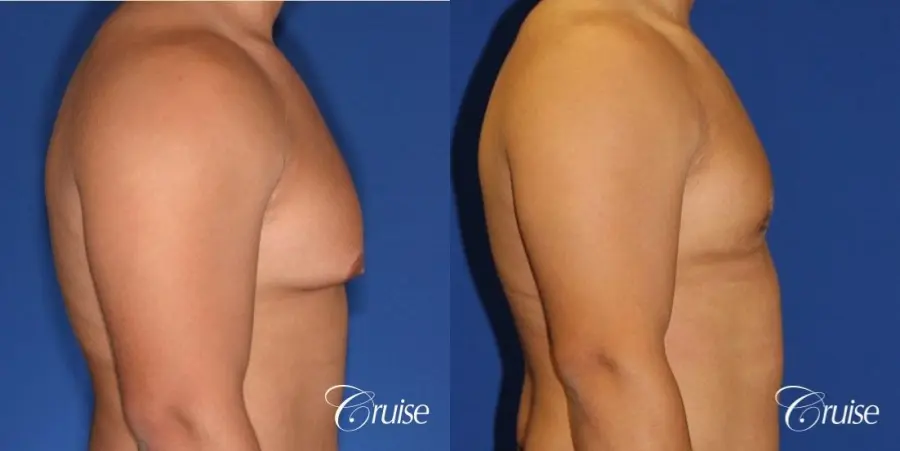 donut lift gynecomastia moderate adult - Before and After 3