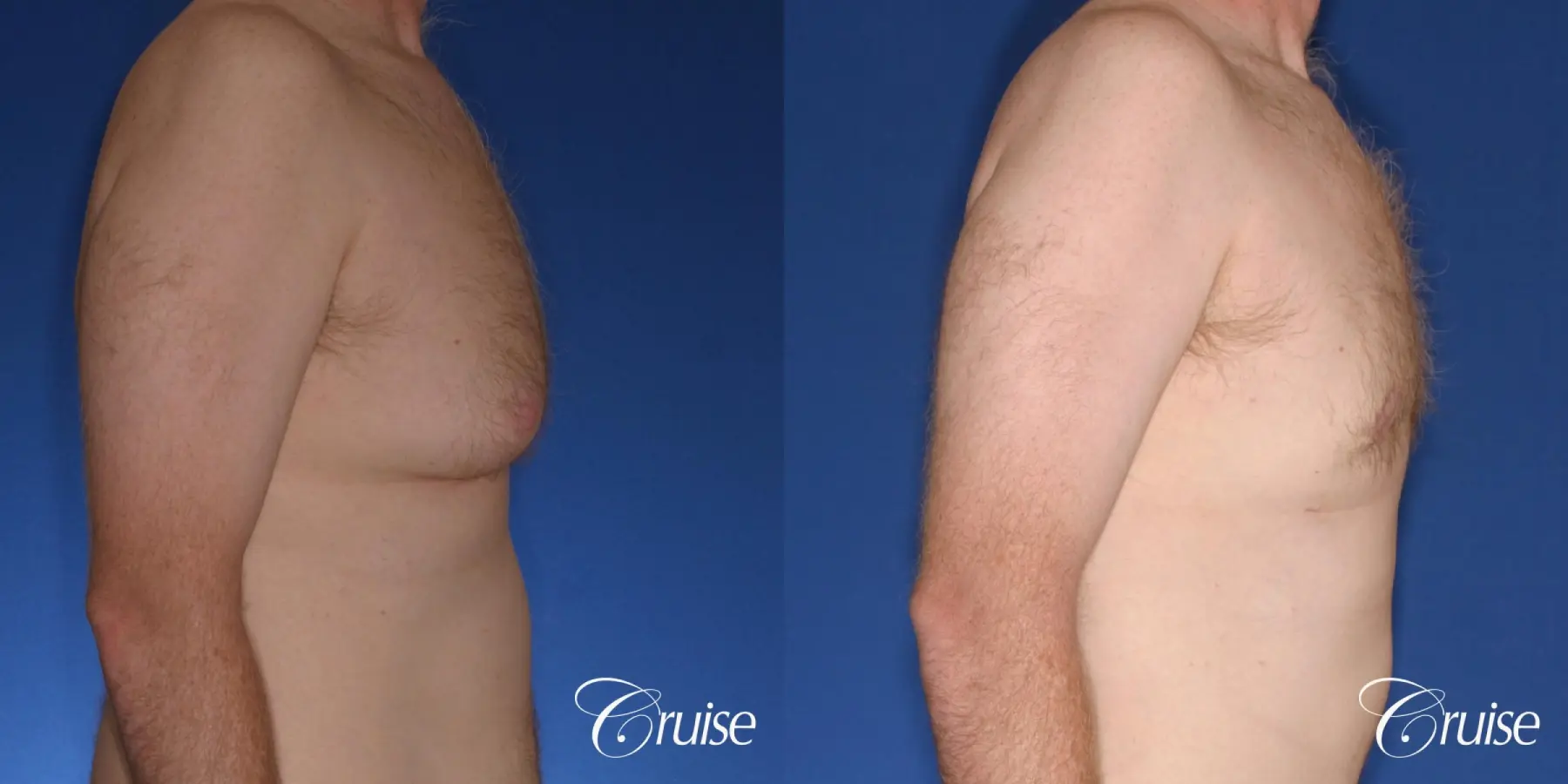 best donut lift with gynecomastia surgery - Before and After 3