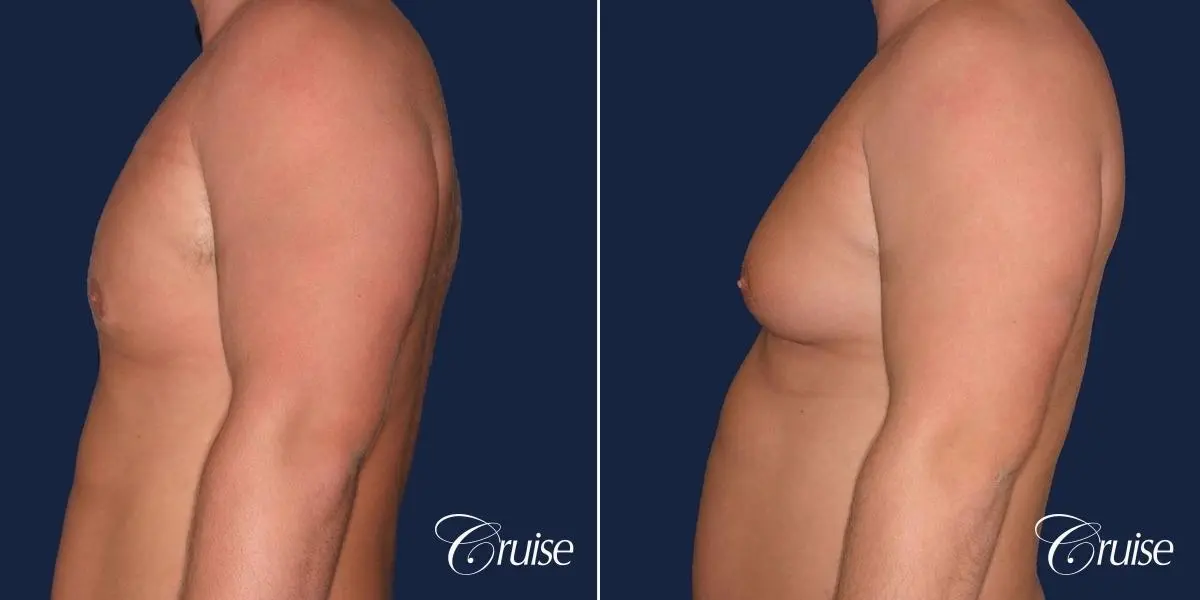 donut lift Gynecomastia correction - Before and After 2