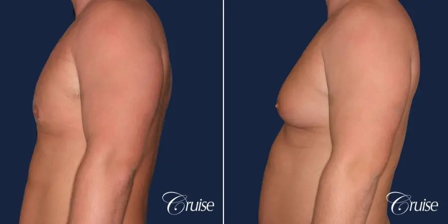 donut lift Gynecomastia correction - Before and After 2