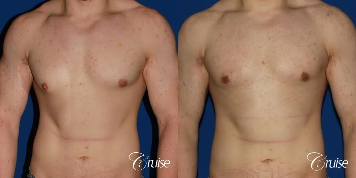 mild-gynecomastia-revision - Before and After 1