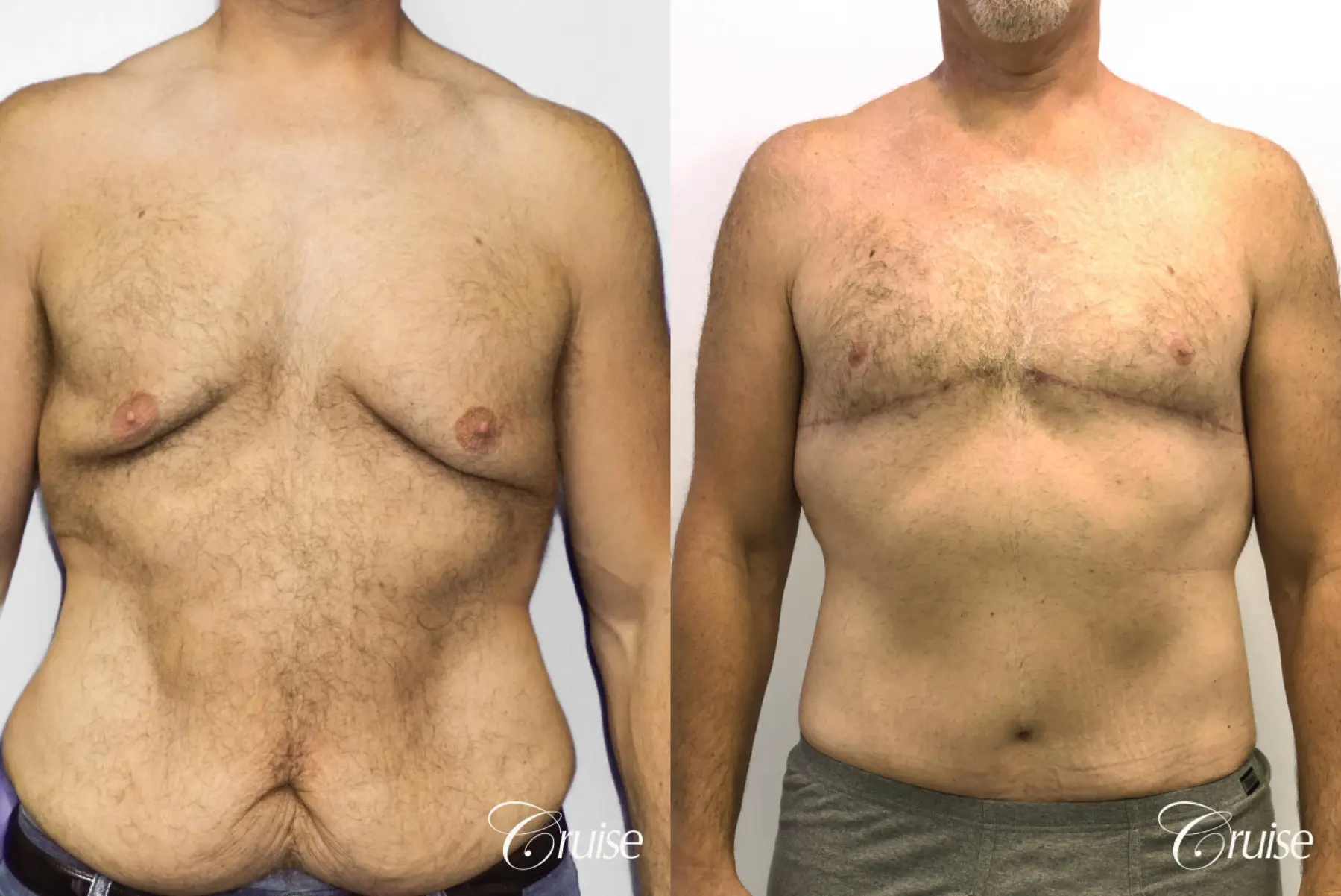 Gynecomastia: Patient 142 - Before and After 1
