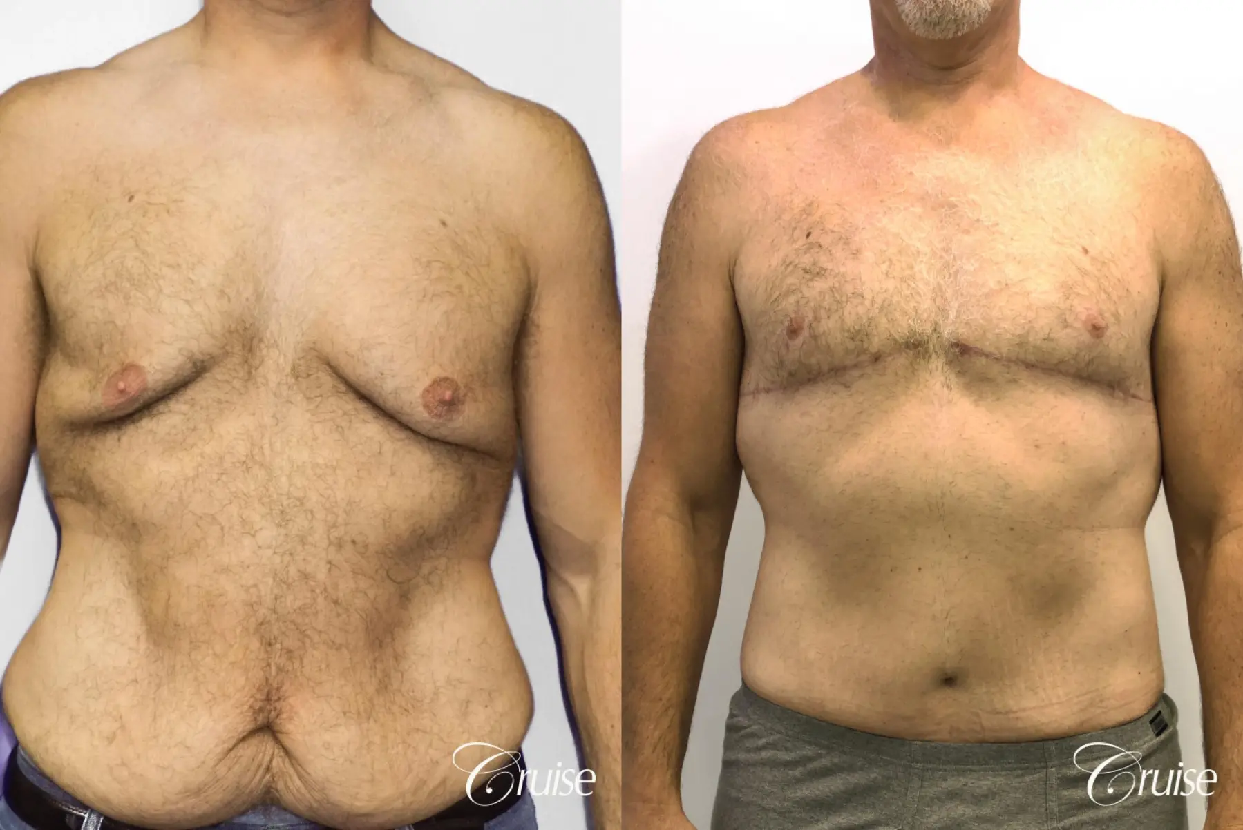 Gynecomastia: Patient 144 - Before and After 1