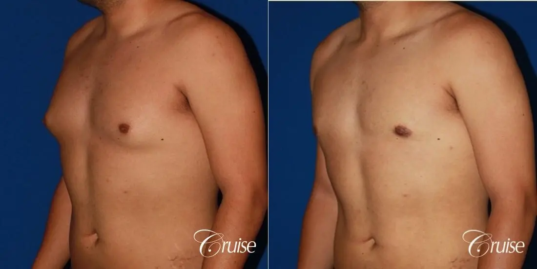 puffy nipple on 26 year old with gynecomastia - Before and After 2
