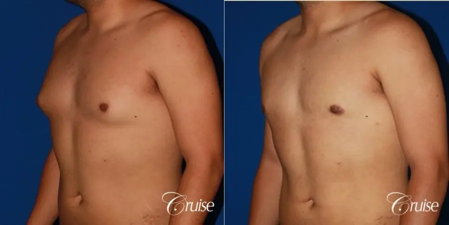 puffy nipple on 26 year old with gynecomastia - Before and After 2