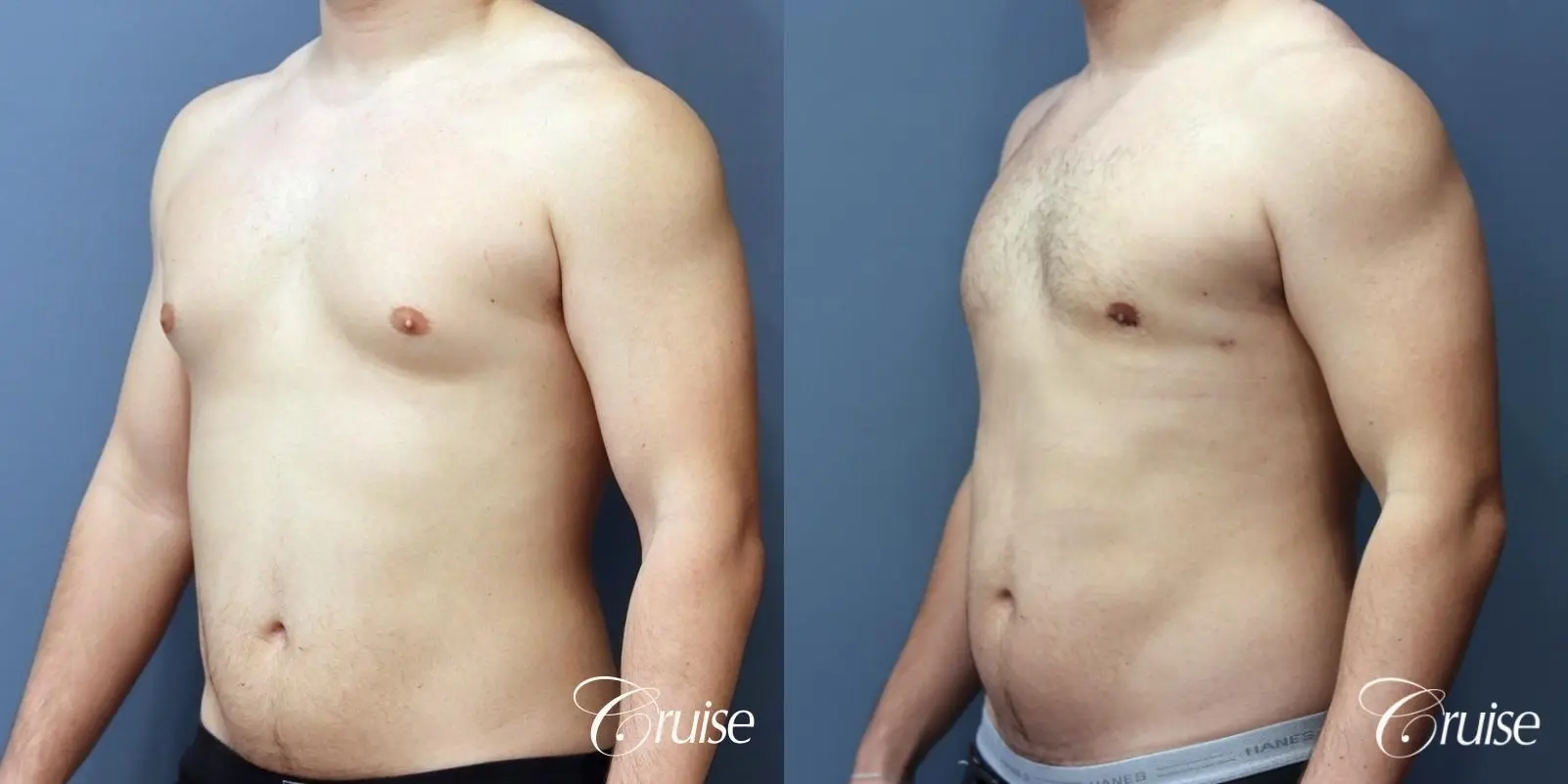 Gynecomastia: Patient 147 - Before and After 2