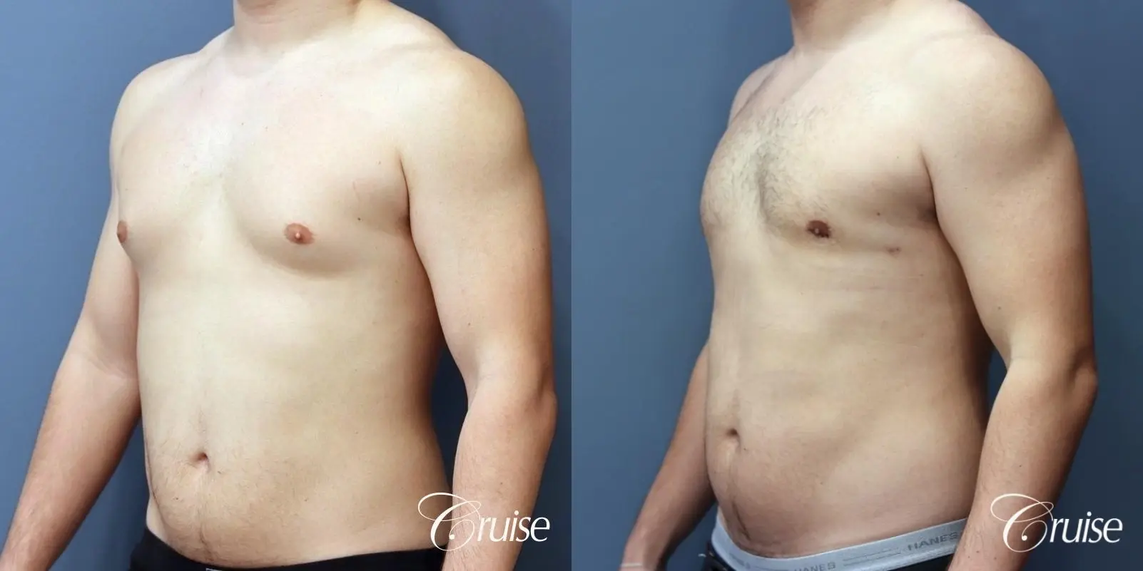 Gynecomastia: Patient 151 - Before and After 2
