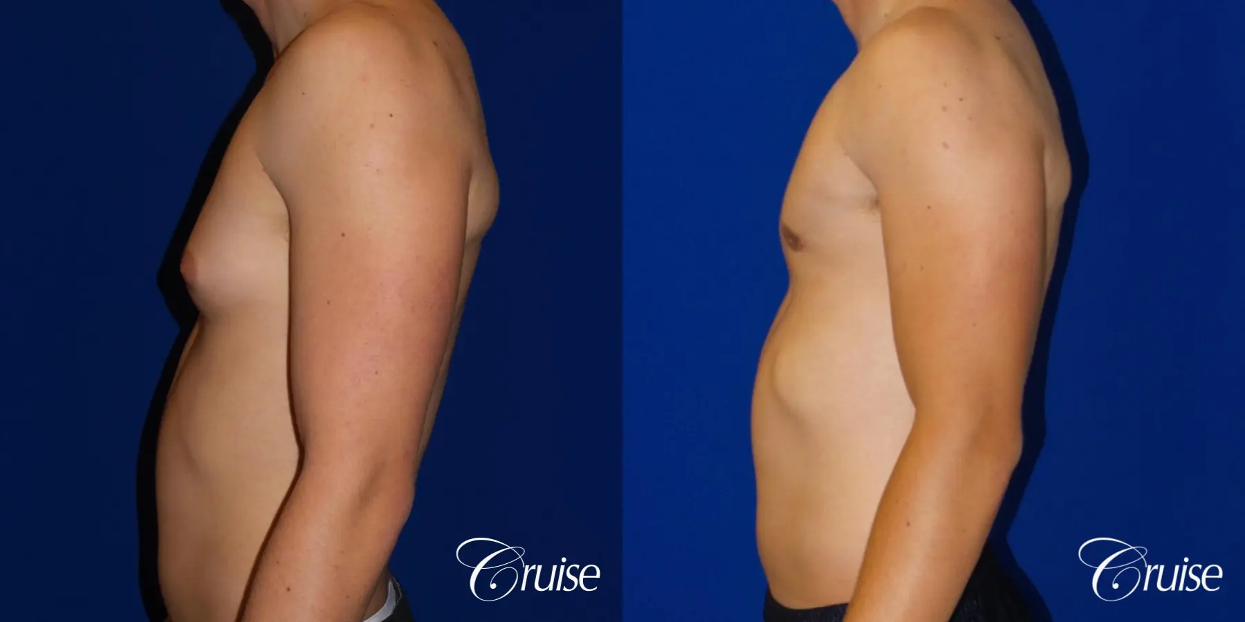 Best moderate gynecomastia on male adult - Before and After 2