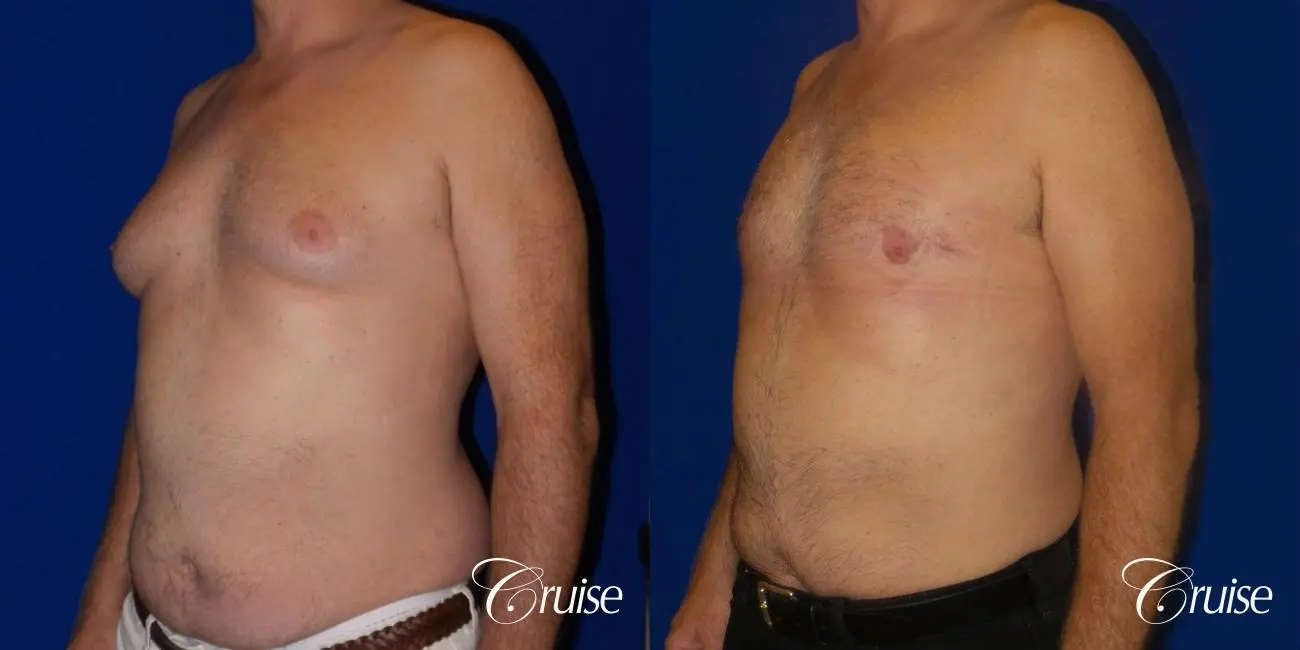 gynecomastia surgery results - Before and After 2