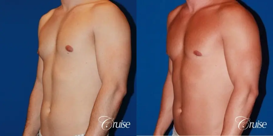 32 yo with Gynecomatia and Puffy Nipple - Before and After 3