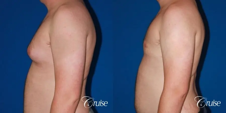 asymmetric gynecomastia moderate - Before and After 3