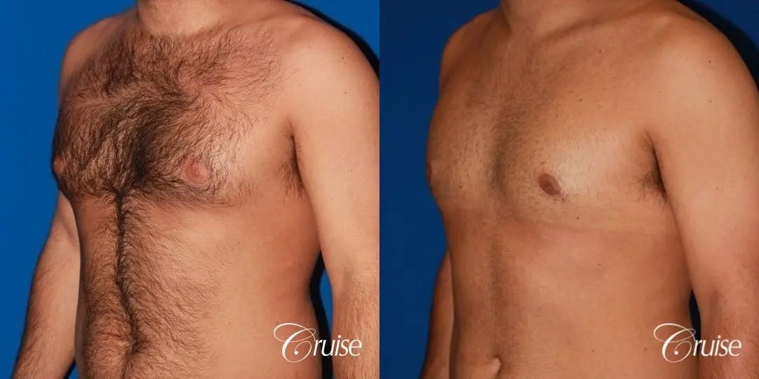 moderate gynecomastia on adult - Before and After 3