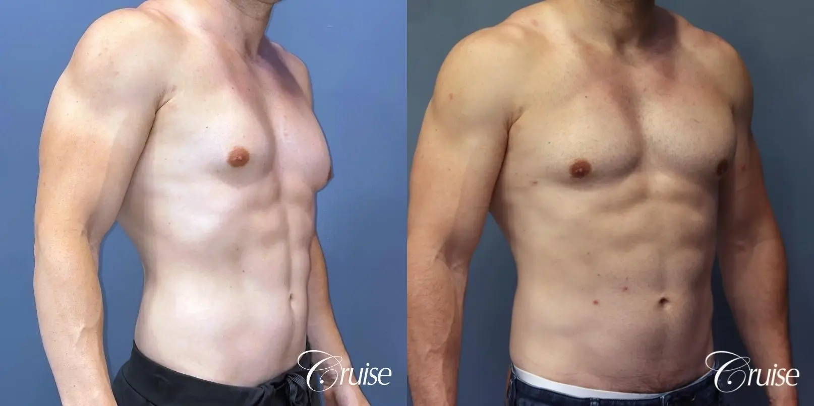 Gynecomastia: Patient 146 - Before and After 4
