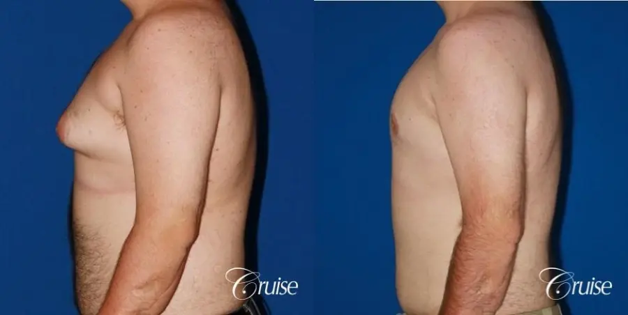 moderate gynecomastia with pointy man boobs - Before and After 2