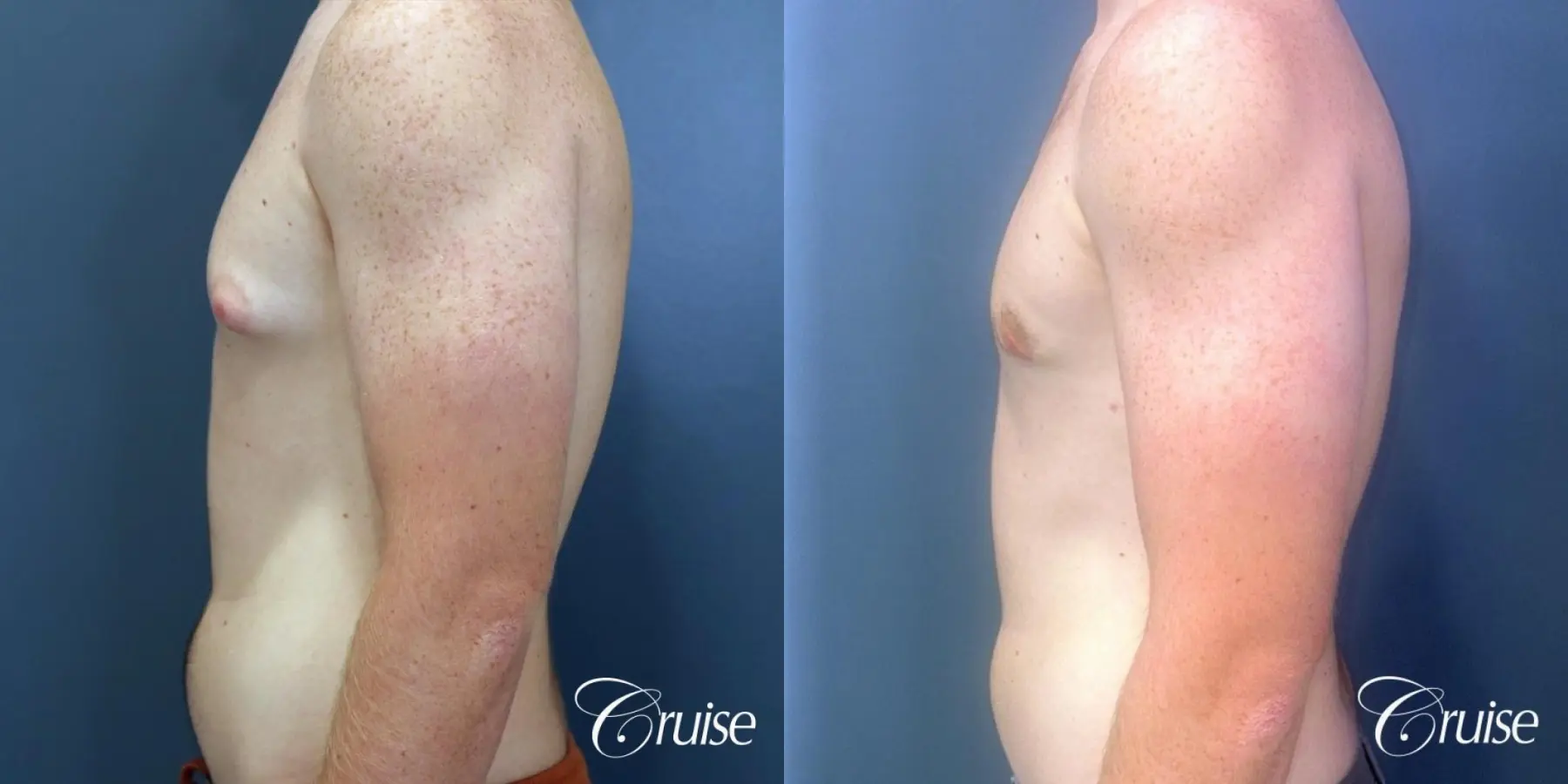 Gynecomastia: Patient 137 - Before and After 3