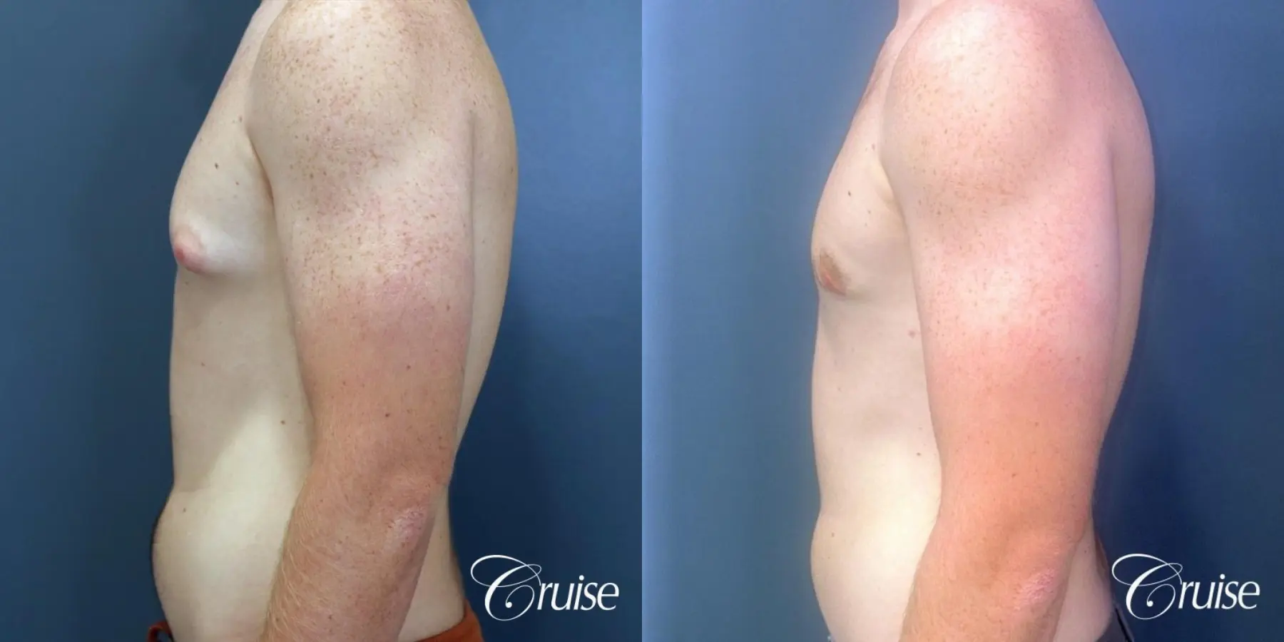 Gynecomastia: Patient 140 - Before and After 3