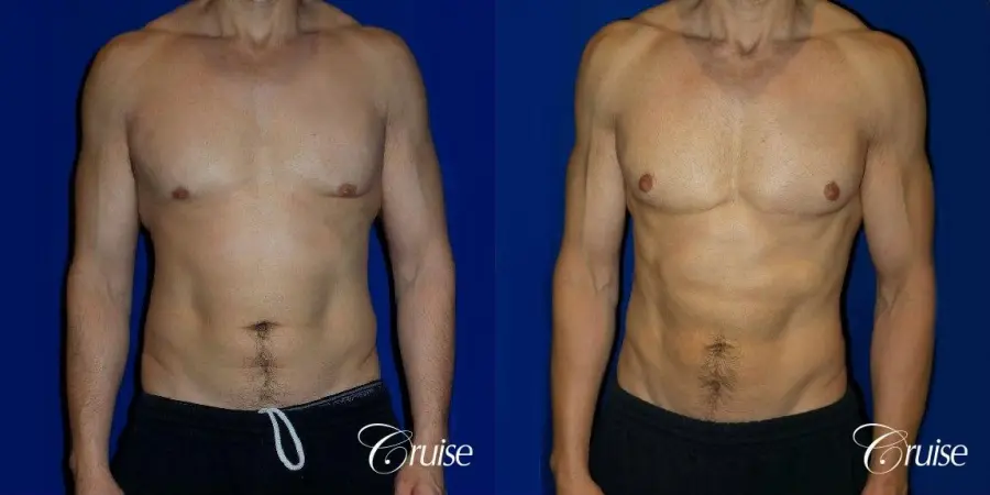 Type 3 Skin Laxity Gynecomastia with Nipple Elevation - Before and After