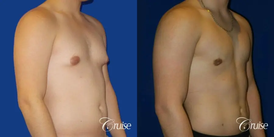 Best Gynecomastia surgeons Southern California - Before and After 4